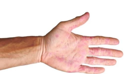 现象|肝不好,手先知!手上若有3种“现象”,建议要做“肝CT”检查了