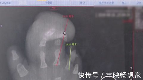 宝宝|得了这病,半岁宝宝脚趾比香蕉还粗!不注意还会复发…