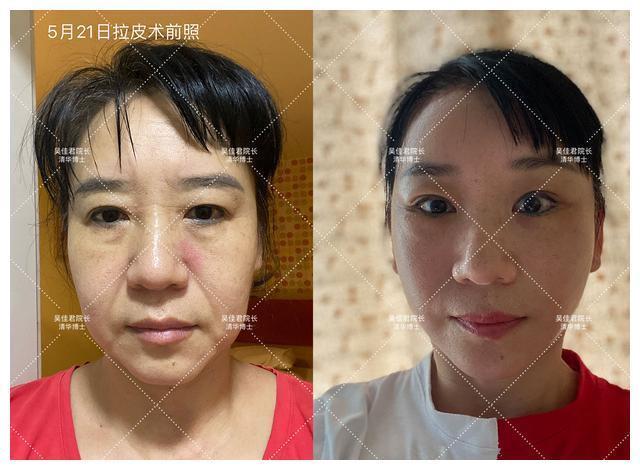 面部 51岁小拉皮术后1个月,我想跟大家说点真心话