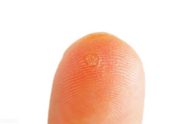 宫颈|女子宫颈病变,后悔大哭,医生忠告皮肤若有2种异常,早查HPV