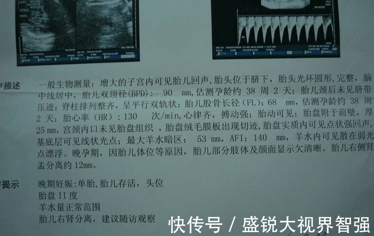 b超|去医院孕检时, 看到B超单子上的这4个字, 你怀的多半是个小王子