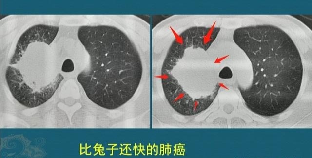  查出来|多数癌症刚查出来能吃能睡，一治疗就变差了，如果不治疗会咋样