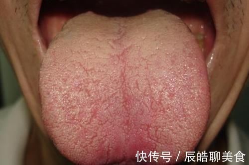 糖尿病|80后精神小伙患2型糖尿病,医生感叹太年轻,5种舌象很常见要当心