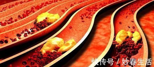 淡黄色|眼睛出现3情况,血脂已经挤满血管,常用2方法,清掉多余血脂