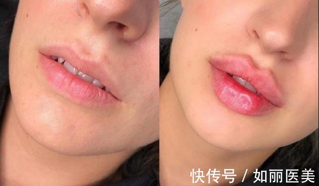 人中 人中长=很显老?“人中缩短手术”可以做吗?