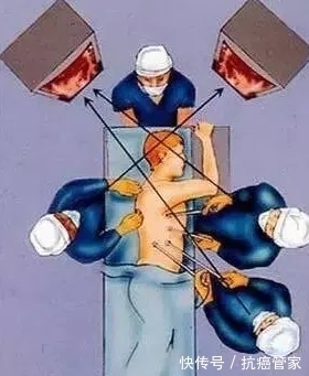 胸腔镜|刘浩医生:注意!要做肺癌手术,先了解这几点—抗癌管家