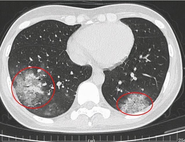 小张|西安一女子持续高烧被送医，竟和养鹦鹉有关