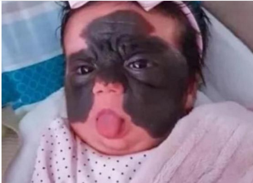 蝙蝠侠|女婴一出生伴随“蝙蝠侠印记”,被父母送去整容7次,结果怎样了