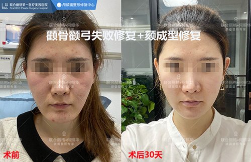 牵拉力|颧骨内推后,面部皮肤一定会下垂吗？看完秒懂