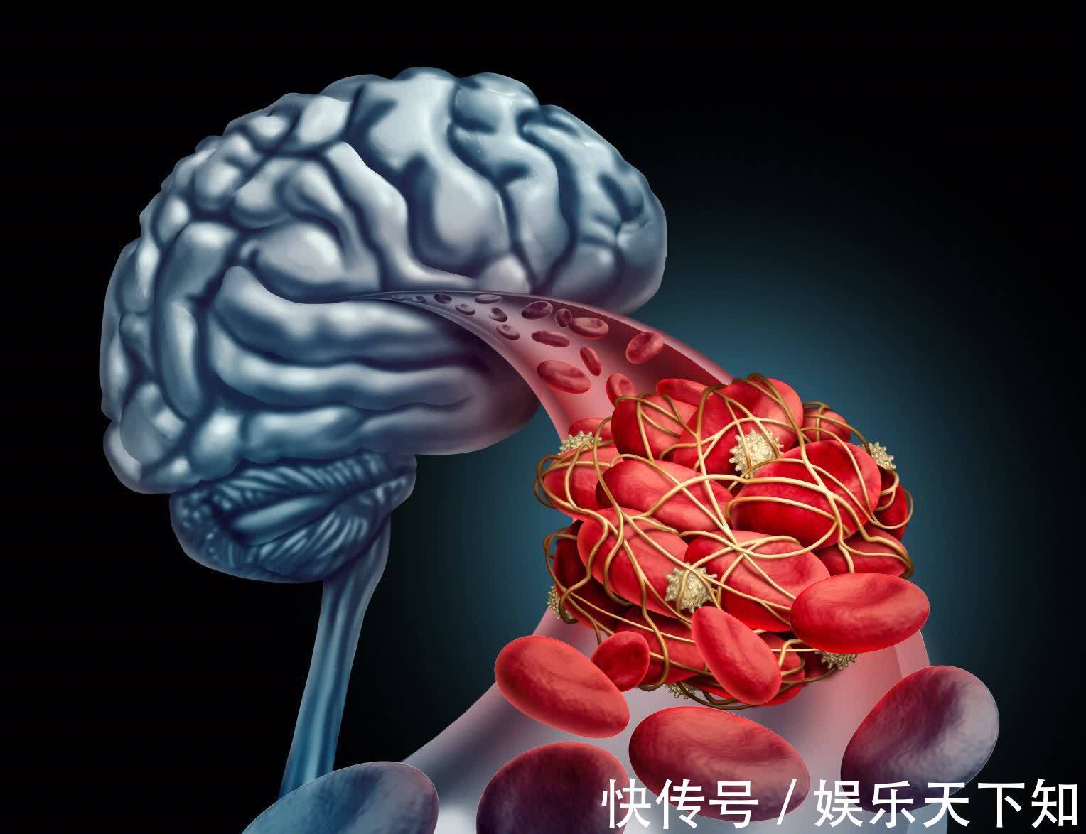 斑块|脑梗不到1年就复发，咋预防？饮食坚持3远2近，脑梗越来越远