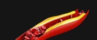 眼睑黄色瘤|高血脂的“祸根”找到了,医生警示:3种食物再吃,血液粘如粥