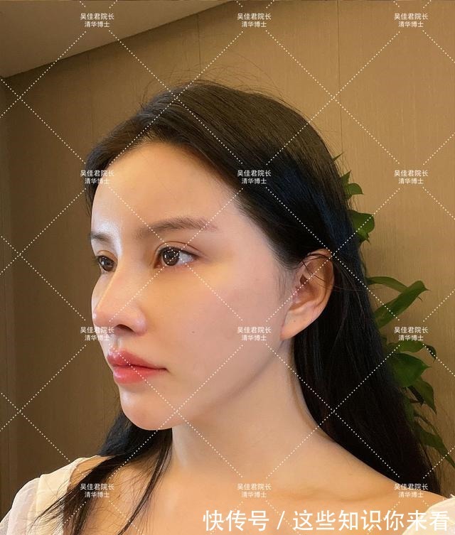 下垂 32岁姑娘小拉皮术后7个半月,变得年轻又精致,前后反差很大!