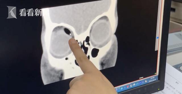 西安市儿童医院|3岁女童摔了一跤筷子戳进鼻子断成两截