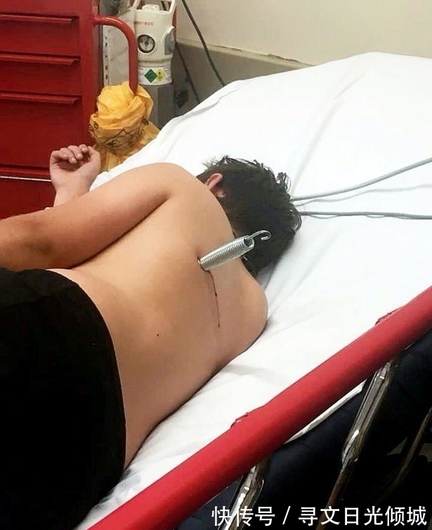 杰米|英国男童玩蹦床,弹簧蹦出插进背部6厘米,父母吓坏:还好不是头