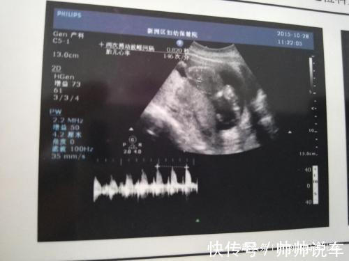 B超|女子“怀孕”3个月,B超显示腹中没有胎儿,孕妇大哭医生却笑了