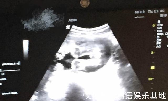 羊水|43岁高龄女子备孕14年喜得贵子,孩子出生第4天,全家被打击到了