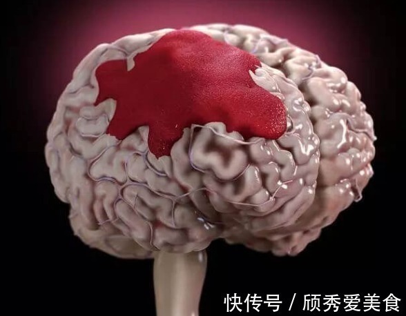 医生|60岁大爷深夜脑出血，医生直言：都这个年纪了，还不懂节制！