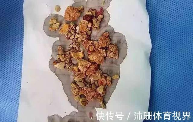 肾结石|5个月宝宝肾结石,医生:都是辅食惹的祸,很多家庭还在这么喂