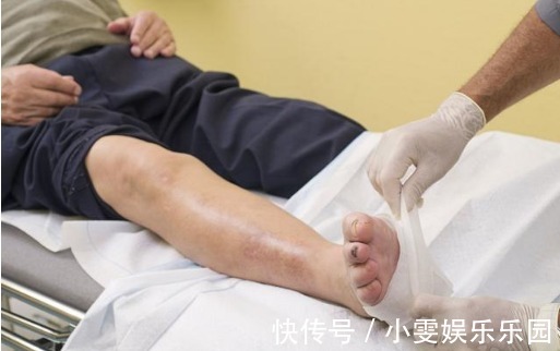 糖尿病足|糖尿病出现这6大表现，证明糖尿病并发症出现，血糖控制不好