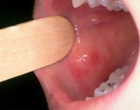 肠道病毒|手足口病、疱疹性咽峡炎夏秋季高发，家长需注意！