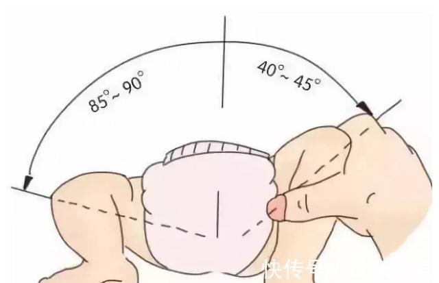 发育性髋关节脱位|宝宝臀纹不对称,家长一定要注意