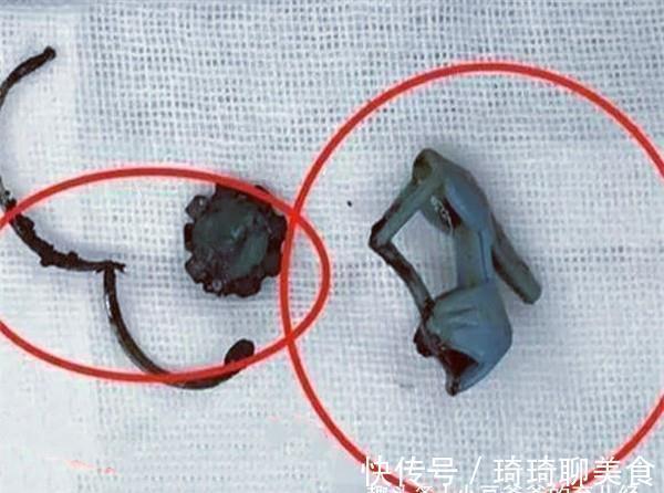 宝妈|6岁女儿身上有异味,医生取出“异物”并怒斥道:妈妈太无知
