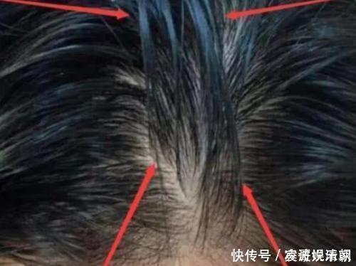 头发|你还在“散头发”睡觉?多数女生做错了,小心变成“秃头女孩”