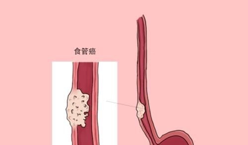 治疗方案|癌细胞明明已经扩散，为什么人依旧很精神，吃的也比较多？