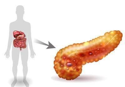 慢性胰腺炎|癌症大多是“拖”出来的？若身体有这3种炎症，最好别拖尽快治疗
