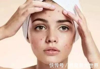 红霉素|红霉素加它敷脸,半个月不到,痘痘、痘印都没了,皮肤还变得嫩滑!