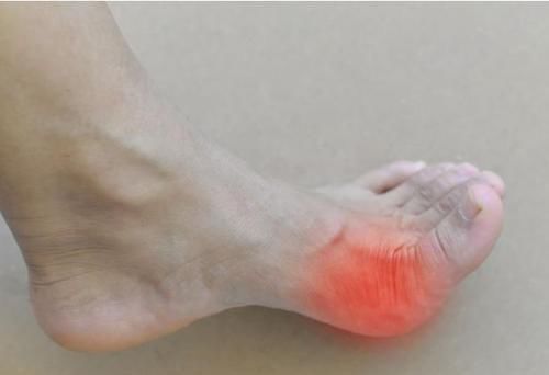  动物|滴酒不沾，却被痛风盯上，医生叹息：这样吃，肾衰竭早晚的事