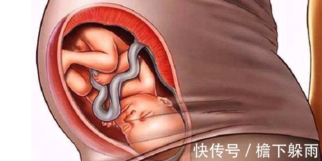 妊娠线|怀孕后，这几个孕期反应若符合2个，可能是小帅哥来找你