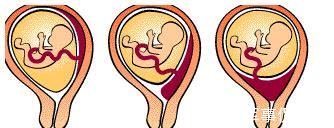 双胞胎|生孩子该选人民医院,还是妇幼医院呢?双胞胎妈妈给出4点建议