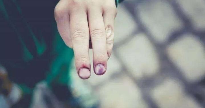 肠胃疾病|3岁小男孩爱啃指甲,妈妈紧急纠正,奶奶:不就吃个手,有啥要紧