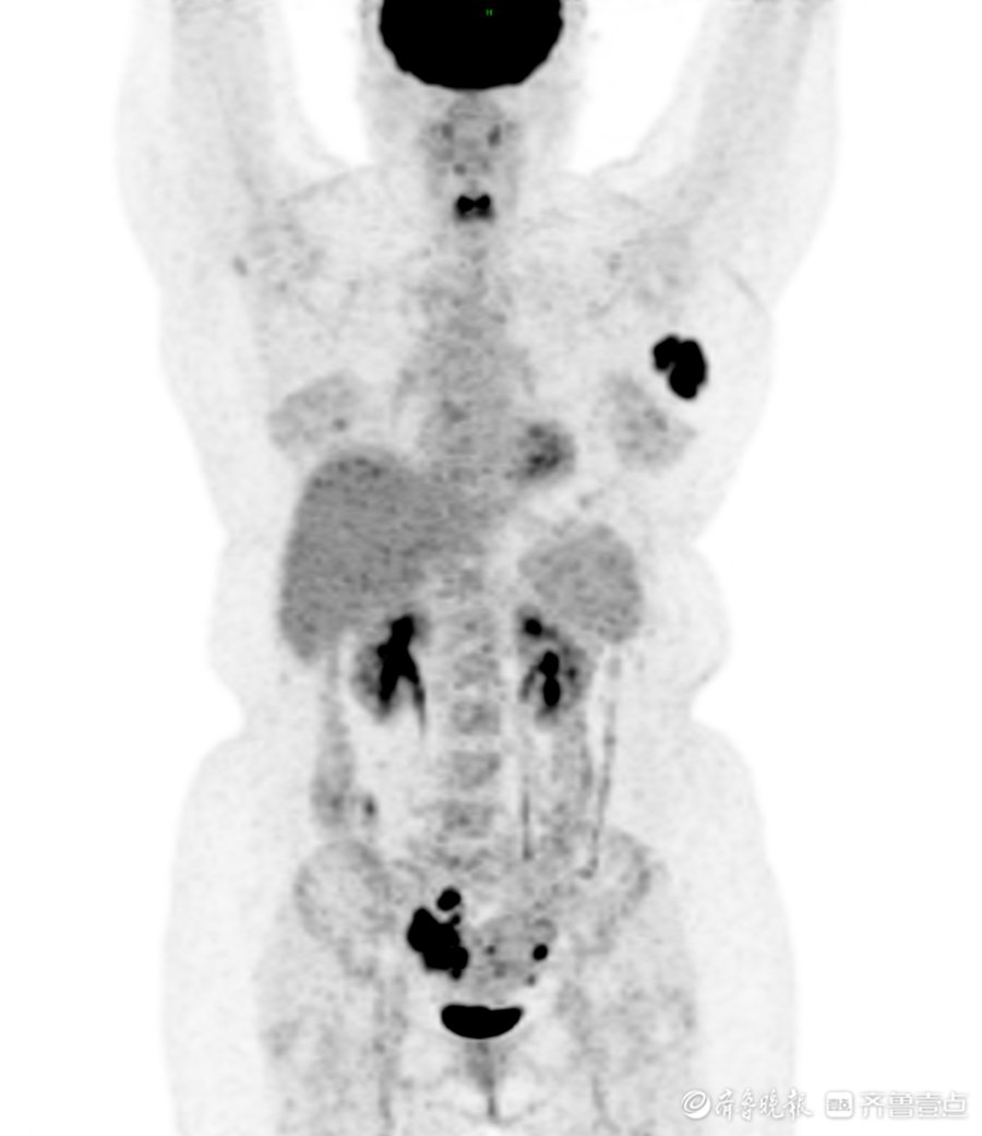 ct|德州市第二人民医院PET/CT“捉妖记”