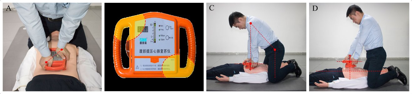 心肺复苏|腹部提压心肺复苏术，该出手时就出手