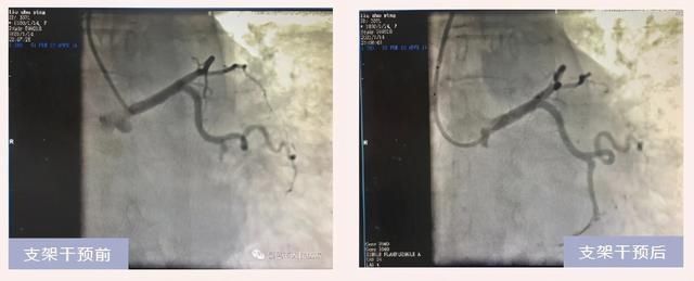 打破高龄记录，91岁急性心肌梗死老人重获新生