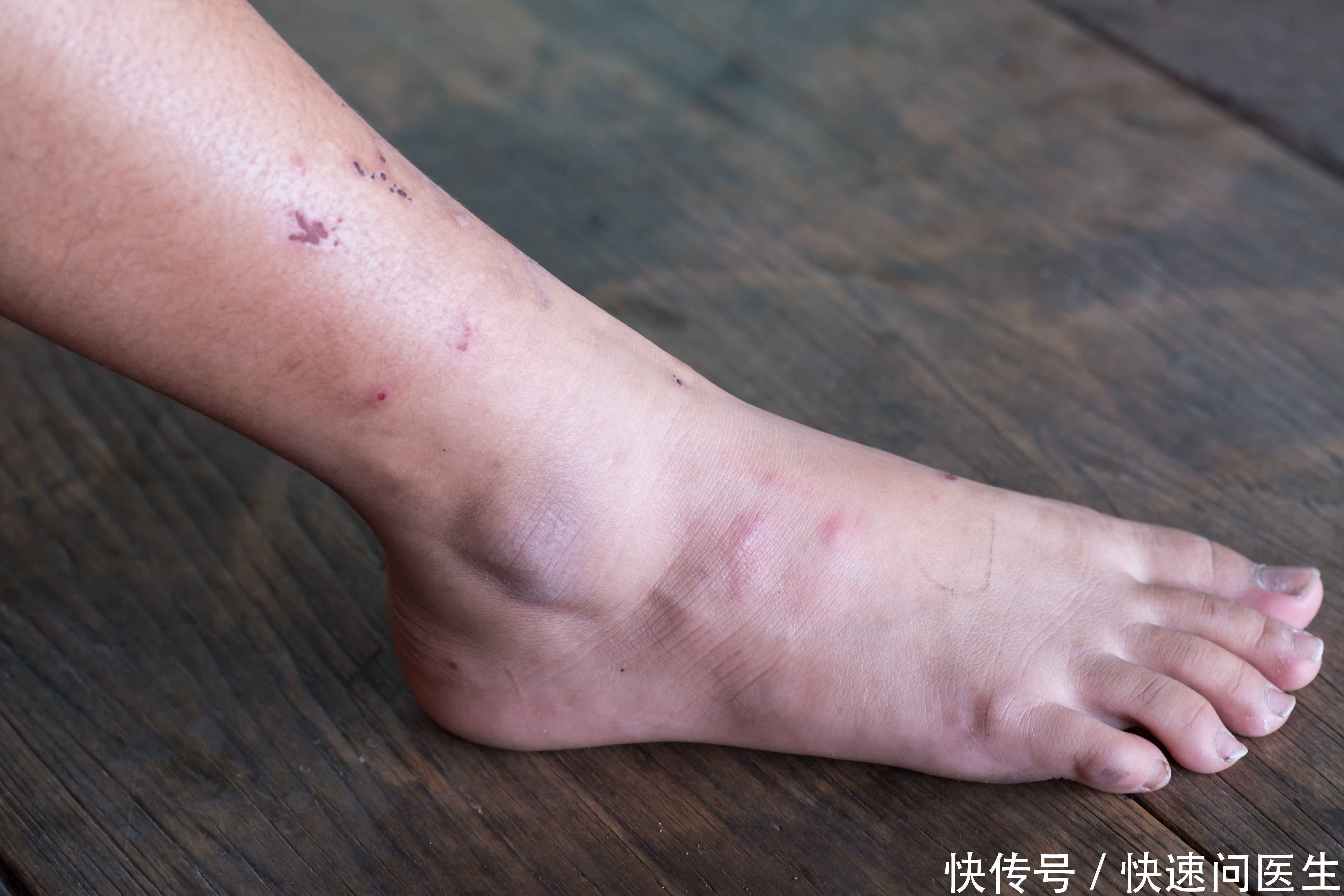 代谢类|糖尿病人留个“心眼”,格外关注腿脚护理,警惕糖尿病足的到来