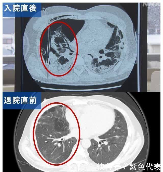 肺部|日本新冠患者2个月的治疗过程 挣扎在生死边缘