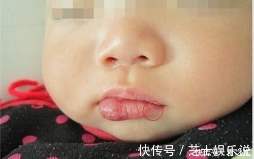 症状|宝宝脸上是海绵状血管瘤吗?家长只要看是否出现这些症状