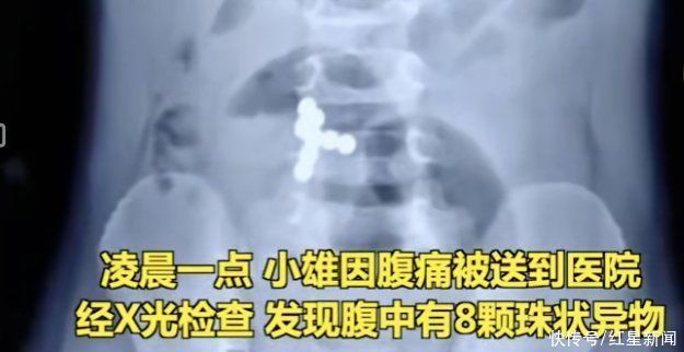 肠穿孔|男童误吞8颗磁力珠导致肠穿孔！市场监管总局最新提示：慎买这3类儿童产品