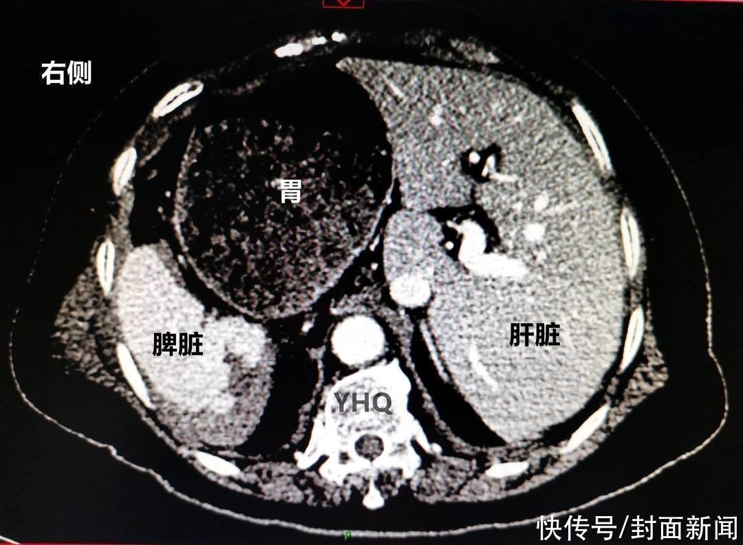 封面新闻|急诊遇上罕见“镜像人”成都专家“逆行”为其手术