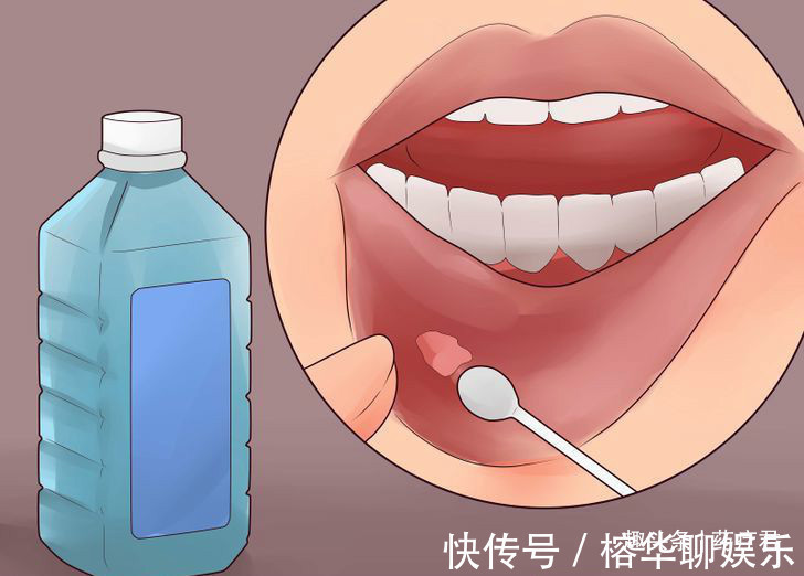 口腔溃疡|嘴巴里隔一段时间就要长溃疡,这是什么原因听听医生怎么说
