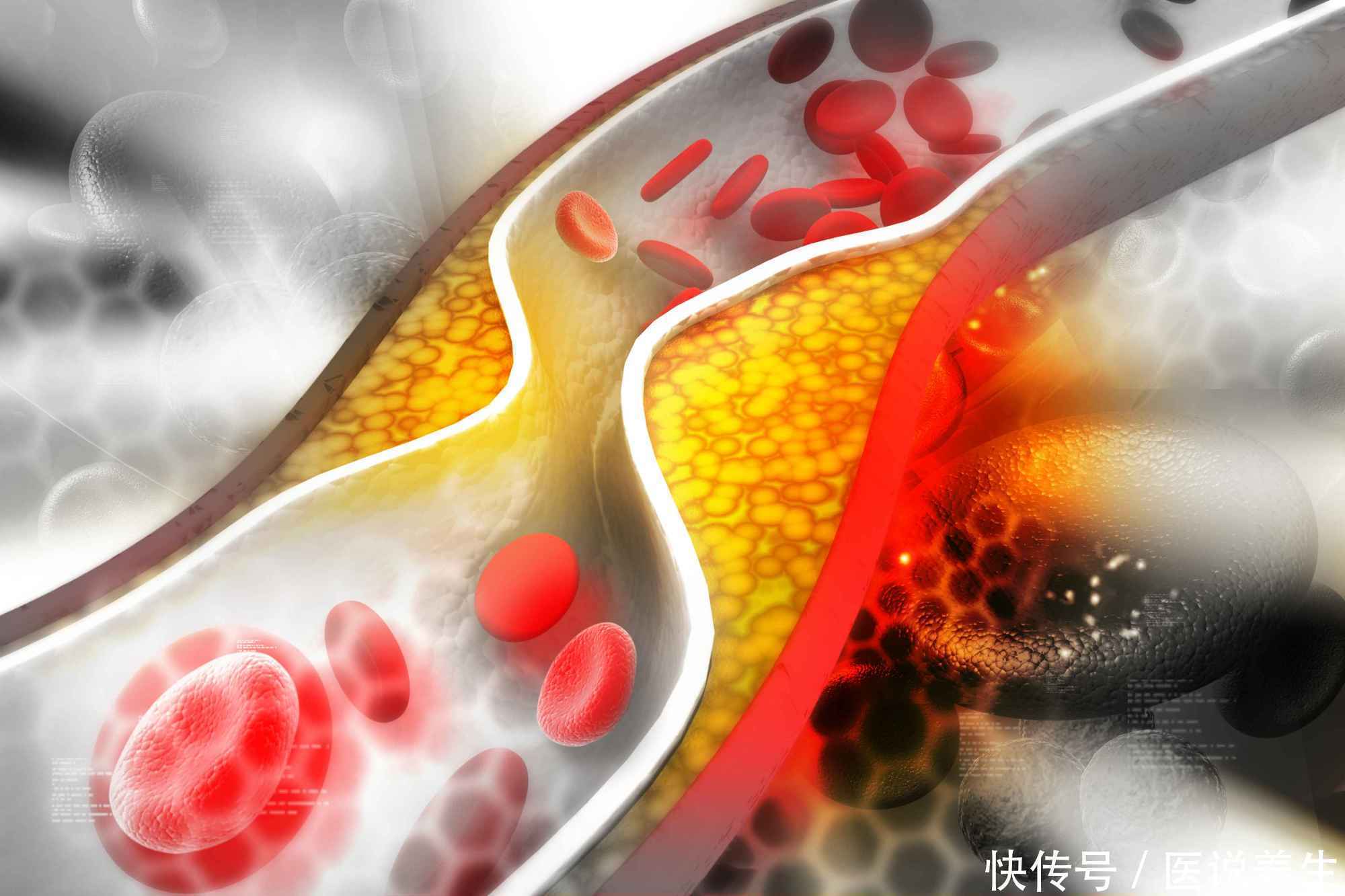 年龄大了，血管“堵了”？黄芪搭配它泡水喝，排出血毒，预防血栓