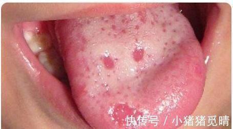 女童|5岁女童积食,父母给吃了2年鸡内金,引起脾胃虚弱,医生:愚昧