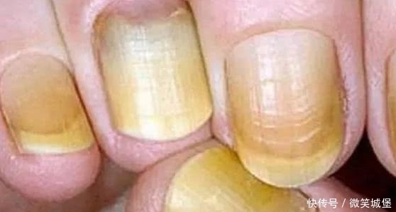 搞错|指甲上的“月牙”越多越健康吗多数人搞错了,不妨看看