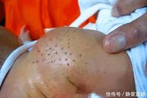拔掉|宝宝身上出“黑刺”,妈妈全部拔掉后宝宝发烧,医生怒斥宝妈无知