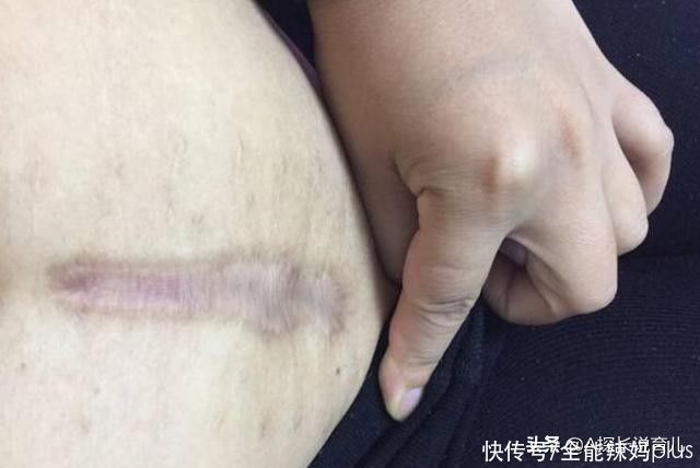 胎儿|顺产虽然“恢复快”，但剖腹产这3大优点，甩顺产“3条街”