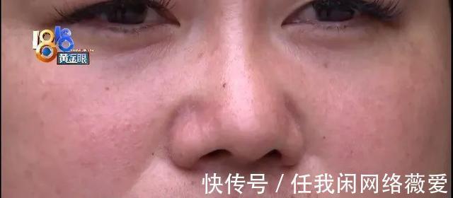 鼻头 做了两次手术,现在两个问题