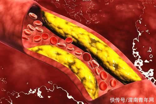 检查|身体若有这4种表现，当心血脂在飙升！应及时检查